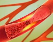Video: L'arteriosclerosi