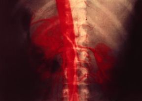 Aortografia translombare. In rosso l'aorta e i suoi rami.De Agostini Picture Library Aortografia translombare. In rosso l'aorta e i suoi rami.De Agostini Picture Library
