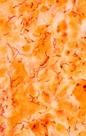 Il batterio della sifilide. Venereologia. Il Treponema pallidum è il batterio responsabile della sifilide, una tipica malattia a trasmissione sessuale. La sifilide congenita può essere trasmessa anche al feto per via transplacentare dopo la quinta settimana. Il batterio della sifilide. Venereologia. Il Treponema pallidum è il batterio responsabile della sifilide, una tipica malattia a trasmissione sessuale. La sifilide congenita può essere trasmessa anche al feto per via transplacentare dopo la quinta settimana.