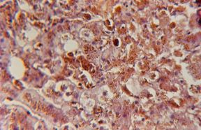 Il diabete mellito. Diabete. Nel tessuto epatico di questo paziente, affetto da diabete mellito, sono evidenti le tracce lasciate dalla sindrome dismetabolica. Il diabete mellito. Diabete. Nel tessuto epatico di questo paziente, affetto da diabete mellito, sono evidenti le tracce lasciate dalla sindrome dismetabolica.