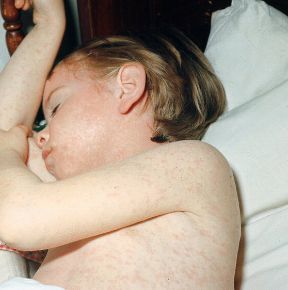 Il morbillo è una tipica malattia infantile. Malattie esantematiche. Il morbillo, tipica malattia infettiva, si presenta con un'eruzione maculo-papulare diffusa di colorito rosso acceso, accompagnata da febbre elevata, tosse, fotofobia e talvolta ingrossamento dei linfonodi. Il morbillo è una tipica malattia infantile. Malattie esantematiche. Il morbillo, tipica malattia infettiva, si presenta con un'eruzione maculo-papulare diffusa di colorito rosso acceso, accompagnata da febbre elevata, tosse, fotofobia e talvolta ingrossamento dei linfonodi.