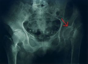 Radiografia del bacino. Bacino. La radiografia mette in rilievo l'osteoporosi a carico delle ossa del bacino. Sono visibili le alterazioni degenerative dovute all'insufficiente elaborazione della matrice proteica (freccia). Radiografia del bacino. Bacino. La radiografia mette in rilievo l'osteoporosi a carico delle ossa del bacino. Sono visibili le alterazioni degenerative dovute all'insufficiente elaborazione della matrice proteica (freccia).