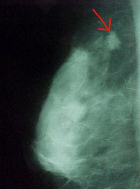 Rappresentazione di una mammografia. Diagnostica. L'esame radiologico diretto della mammella, o mammografia, è un importante strumento di radiodiagnostica. Consente infatti di visualizzare tutte le componenti anatomiche di questa struttura ghiandolare e di evidenziarne eventualmente le alterazioni patologiche. La freccia indica un nodulo mammario neoplastico. Rappresentazione di una mammografia. Diagnostica. L'esame radiologico diretto della mammella, o mammografia, è un importante strumento di radiodiagnostica. Consente infatti di visualizzare tutte le componenti anatomiche di questa struttura ghiandolare e di evidenziarne eventualmente le alterazioni patologiche. La freccia indica un nodulo mammario neoplastico.