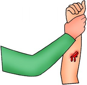 Controllo della perdita di sangue in caso di ferita. Emorragie esterne. Per controllare la perdita di sangue si può sollevare la parte ferita in modo che si trovi sopra il livello del cuore. Controllo della perdita di sangue in caso di ferita. Emorragie esterne. Per controllare la perdita di sangue si può sollevare la parte ferita in modo che si trovi sopra il livello del cuore.