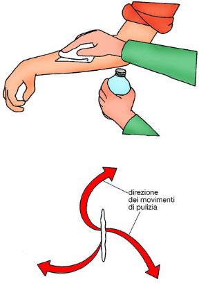 Ferita semplice: disinfezione della ferita. Ferite semplici ed escoriazioni. Prima di usare il disinfettante, procedere alla pulizia della ferita. Ferita semplice: disinfezione della ferita. Ferite semplici ed escoriazioni. Prima di usare il disinfettante, procedere alla pulizia della ferita.