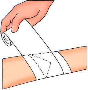 Effettuare una corretta fasciatura: avvolgimento della benda. Come fare una fasciatura. Attorno all’arto, la benda va avvolta a spirale. Effettuare una corretta fasciatura: avvolgimento della benda. Come fare una fasciatura. Attorno all’arto, la benda va avvolta a spirale.