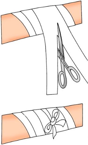 Effettuare una corretta fasciatura: fissaggio della medicazione. Come fare una fasciatura. Dopo aver avvolto la benda a spirale, tagliare l’ultimo tratto di benda. Effettuare una corretta fasciatura: fissaggio della medicazione. Come fare una fasciatura. Dopo aver avvolto la benda a spirale, tagliare l’ultimo tratto di benda.
