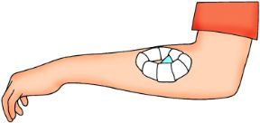 Intervento su ferita con corpo estraneo: applicazione del tampone. Ferite con corpo estraneo. Avrete così ottenuto un tampone ad anello da applicare sulla ferita senza toccare il corpo estraneo. Intervento su ferita con corpo estraneo: applicazione del tampone. Ferite con corpo estraneo. Avrete così ottenuto un tampone ad anello da applicare sulla ferita senza toccare il corpo estraneo.