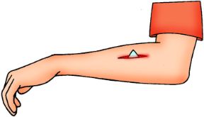 Intervento su ferita con corpo estraneo: non rimuovere il corpo estraneo. Ferite con corpo estraneo. Il corpo estraneo in una ferita non va estratto direttamente per evitare danni maggiori. Intervento su ferita con corpo estraneo: non rimuovere il corpo estraneo. Ferite con corpo estraneo. Il corpo estraneo in una ferita non va estratto direttamente per evitare danni maggiori.