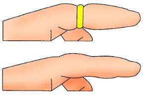 Intervento in caso di ustione lieve. Eliminare anelli dalla parte scottata. Ustioni lievi. Togliete anelli, orologi e costrizioni varie dalla parte scottata.