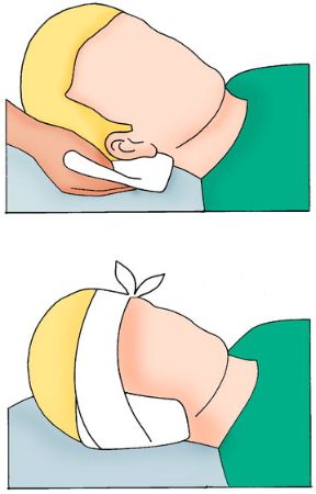 Intervento in caso di otarragia: applicazione di una garza. Otarragia. Applicate sull’orecchio una compressa di garza sterile o un fazzoletto pulito e fermate con una benda. Intervento in caso di otarragia: applicazione di una garza. Otarragia. Applicate sull’orecchio una compressa di garza sterile o un fazzoletto pulito e fermate con una benda.