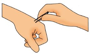 Punture di insetti. Rimozione del pungiglione. Punture di insetti. L’eventuale pungiglione va tolto. Punture di insetti. Rimozione del pungiglione. Punture di insetti. L’eventuale pungiglione va tolto.