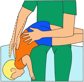 Primo soccorso per i bambini. Liberazione delle vie respiratorie. Primo soccorso per neonati e bambini. Se non riesce a tossire intervenite immediatamente con alcuni colpetti decisi in rapida successione tra le scapole.