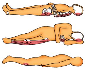 Come evitare piaghe da decubito. Decubito. Una prolungata permanenza a letto, soprattutto nei pazienti anziani, può causare gravi complicazioni come le piaghe da decupito. Come evitare piaghe da decubito. Decubito. Una prolungata permanenza a letto, soprattutto nei pazienti anziani, può causare gravi complicazioni come le piaghe da decupito.