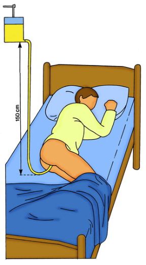 Il clistere. Clistere. Il clistere consiste nell'introduzione di liquido in quantità variabili nell'ultimo tratto dell'intestino tramite una sonda inserita nel retto. Il clistere. Clistere. Il clistere consiste nell'introduzione di liquido in quantità variabili nell'ultimo tratto dell'intestino tramite una sonda inserita nel retto.