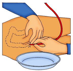 Come eseguire un clistere: inserimento della sonda. Il clistere. Evitare forzature durante l’inserimento della sonda e nel caso si percepisca un ostacolo desistere e informare il medico. Come eseguire un clistere: inserimento della sonda. Il clistere. Evitare forzature durante l’inserimento della sonda e nel caso si percepisca un ostacolo desistere e informare il medico.