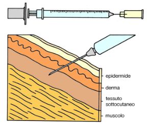 Schema per effettuare l''iniezione sottocutanea. L'iniezione. L'iniezione sottocutanea è un tipo di somministrazione utilizzata per ottenere un assorbimento lento e progressivo del farmaco.
