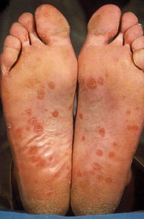 Caso di sifilide secondaria. Dermatologia. La sifilide secondaria si manifesta a livello cutaneo con maculo-papule eritematose che possono localizzarsi al palmo delle mani, o alla pianta dei piedi, come in questo caso. Caso di sifilide secondaria. Dermatologia. La sifilide secondaria si manifesta a livello cutaneo con maculo-papule eritematose che possono localizzarsi al palmo delle mani, o alla pianta dei piedi, come in questo caso.