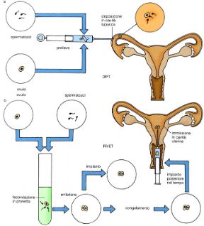 I due metodi della inseminazione artificiale. Inseminazione artificiale. a: GIFT, i gameti vengono introdotti nella tuba; b: FIVET, l’uovo già fecondato in vitro viene posto nella cavità uterina perché si impianti. I due metodi della inseminazione artificiale. Inseminazione artificiale. a: GIFT, i gameti vengono introdotti nella tuba; b: FIVET, l’uovo già fecondato in vitro viene posto nella cavità uterina perché si impianti.