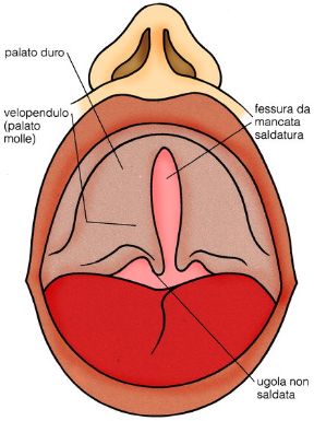 Rappresentazione della palatoschisi. Palatoschisi. La palatoschisi è una delle malattie ereditarie che colpiscono i bambini. Può essere accompagnata da labbro leporino. Rappresentazione della palatoschisi. Palatoschisi. La palatoschisi è una delle malattie ereditarie che colpiscono i bambini. Può essere accompagnata da labbro leporino.