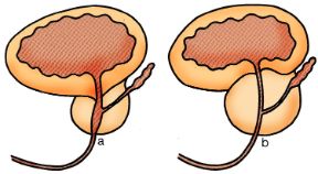 Raffigurazione della prostata. Prostata. a: prostata normale; b: la prostata ipertrofica ostacola lo svuotamento della vescica, la cui parete si ispessisce per compenso. Raffigurazione della prostata. Prostata. a: prostata normale; b: la prostata ipertrofica ostacola lo svuotamento della vescica, la cui parete si ispessisce per compenso.