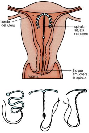Metodi contraccettivi: la spirale. Spirale. I presidi tecnologici o farmacologici per la contraccezione agiscono impedendo il contatto tra spermatozoi e ovulo oppure modificando le caratteristiche del muco cervicale, bloccando l’ovulazione, alterando la mobilità delle tube, interferendo con l’annidamento nell’utero dell’ovulo: i più utilizzati sono il preservativo, la pillola, la spirale (in figura), il diaframma, gli spermicidi. Metodi contraccettivi: la spirale. Spirale. I presidi tecnologici o farmacologici per la contraccezione agiscono impedendo il contatto tra spermatozoi e ovulo oppure modificando le caratteristiche del muco cervicale, bloccando l’ovulazione, alterando la mobilità delle tube, interferendo con l’annidamento nell’utero dell’ovulo: i più utilizzati sono il preservativo, la pillola, la spirale (in figura), il diaframma, gli spermicidi.