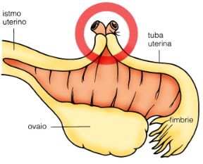 Intervento di chiusura delle tube. Chiusura delle tube. La legatura delle salpingi uterine è una tecnica di sterilizzazione femminile che impedisce il passaggio dell'uovo nella cavità uterina. Intervento di chiusura delle tube. Chiusura delle tube. La legatura delle salpingi uterine è una tecnica di sterilizzazione femminile che impedisce il passaggio dell'uovo nella cavità uterina.