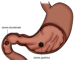 Illustrazione dell'ulcera peptica. Ulcera peptica. Le localizzazioni più frequenti dell'ulcera sono quella gastrica e quella duodenale. L'ulcera è una tipica malattia di tipo psicosomatico la cui insorgenza può essere correlata ad alti livelli di stress. Illustrazione dell'ulcera peptica. Ulcera peptica. Le localizzazioni più frequenti dell'ulcera sono quella gastrica e quella duodenale. L'ulcera è una tipica malattia di tipo psicosomatico la cui insorgenza può essere correlata ad alti livelli di stress.