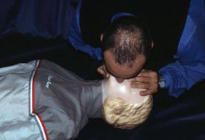 Arresto respiratorio. Insufflazione di aria. Arresto respiratorio. Se il soggetto è privo di sensi e non respira va posto in posizione supina e va effettuata la respirazione artificiale. Arresto respiratorio. Insufflazione di aria. Arresto respiratorio. Se il soggetto è privo di sensi e non respira va posto in posizione supina e va effettuata la respirazione artificiale.