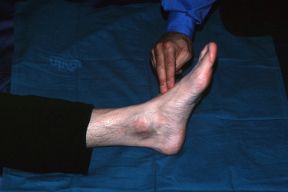 Rilevazione del polso pedidio. Rilevazione del polso pedidio. In caso di frattura agli arti inferiori, valutate la circolazione e la sensibilità distalmente al sito della lesione e ricercate il polso pedidio (arteria pedidia). Rilevazione del polso pedidio. Rilevazione del polso pedidio. In caso di frattura agli arti inferiori, valutate la circolazione e la sensibilità distalmente al sito della lesione e ricercate il polso pedidio (arteria pedidia).