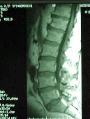 RMN spinale. Risonanza magnetica nucleare. La RMN della colonna vertebrale permette di evidenziare in dettaglio le strutture ossee e legamentose della colonna.
