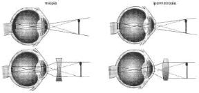 Figura 23.10 I difetti della vista: nel caso della miopia (A) l'immagine si forma davanti alla retina e la correzione avviene utilizzando lenti divergenti; nell'ipermetropia (B) l'immagine si forma oltre la retina e la correzione avviene con lenti convergenti. Figura 23.10 I difetti della vista: nel caso della miopia (A) l'immagine si forma davanti alla retina e la correzione avviene utilizzando lenti divergenti; nell'ipermetropia (B) l'immagine si forma oltre la retina e la correzione avviene con lenti convergenti.